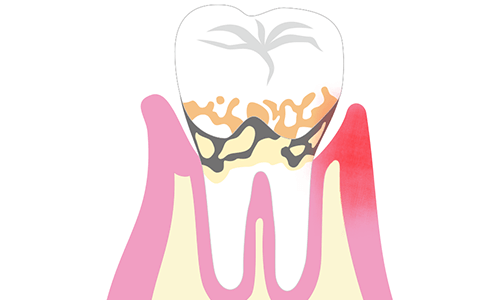 歯周病とははイメージ画像01